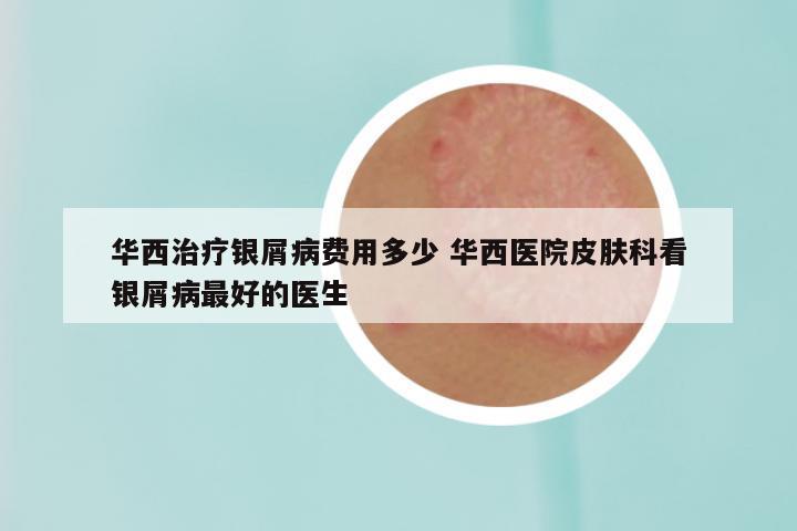 华西治疗银屑病费用多少 华西医院皮肤科看银屑病最好的医生