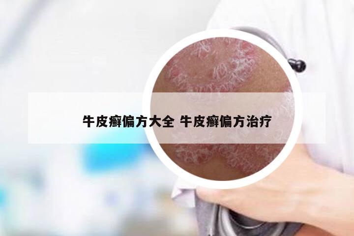 牛皮癣偏方大全 牛皮癣偏方治疗