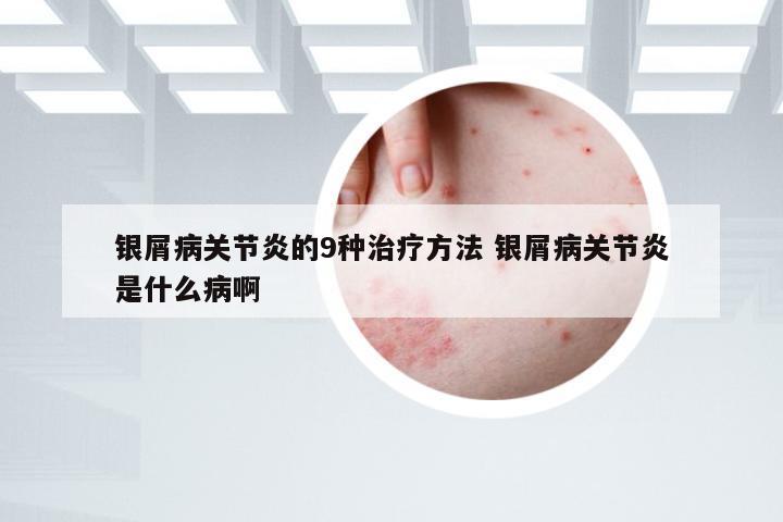 银屑病关节炎的9种治疗方法 银屑病关节炎是什么病啊