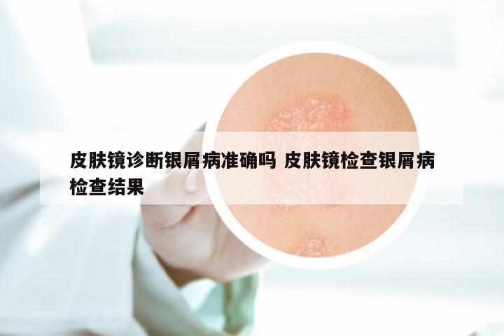皮肤镜诊断银屑病准确吗 皮肤镜检查银屑病检查结果