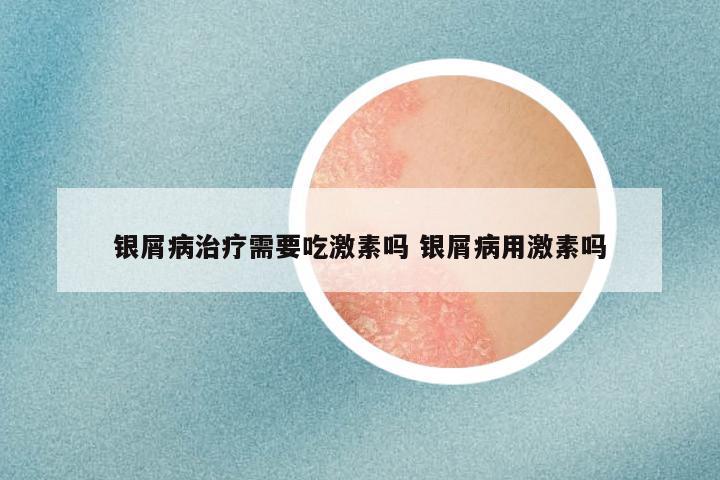 银屑病治疗需要吃激素吗 银屑病用激素吗