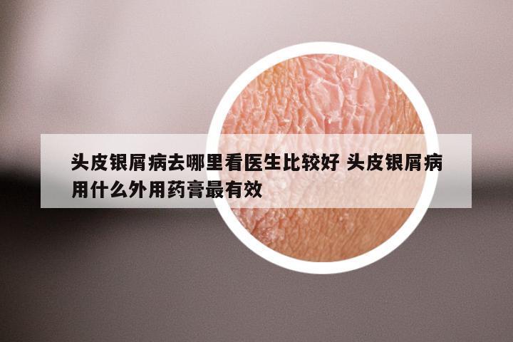 头皮银屑病去哪里看医生比较好 头皮银屑病用什么外用药膏最有效