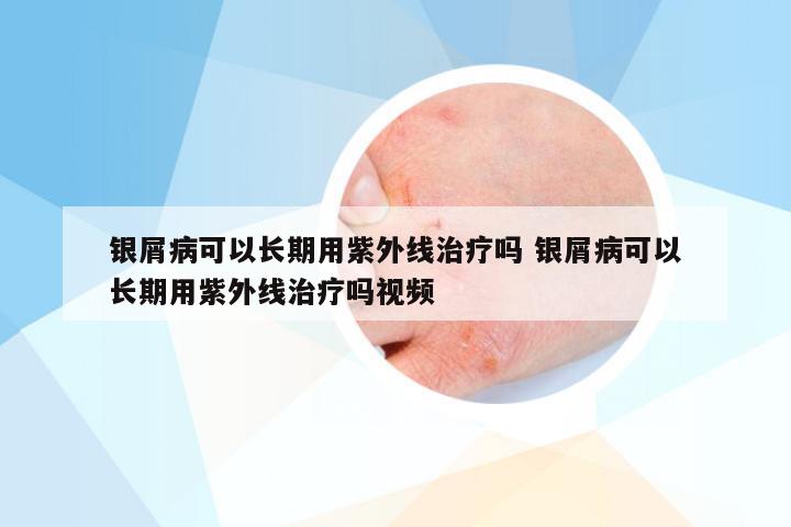 银屑病可以长期用紫外线治疗吗 银屑病可以长期用紫外线治疗吗视频