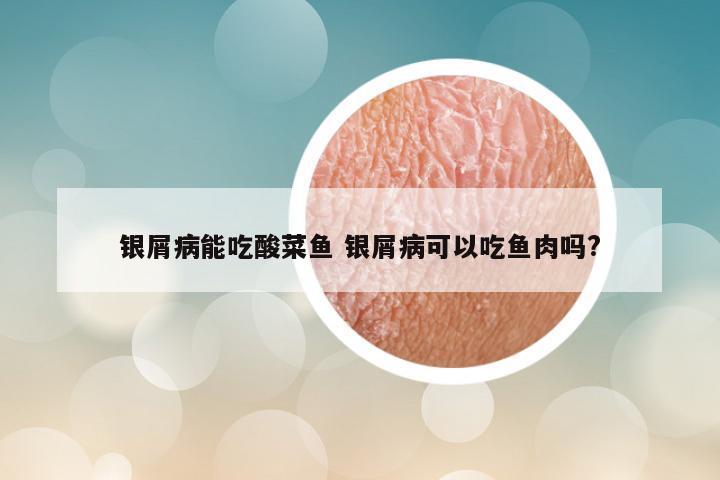 银屑病能吃酸菜鱼 银屑病可以吃鱼肉吗?