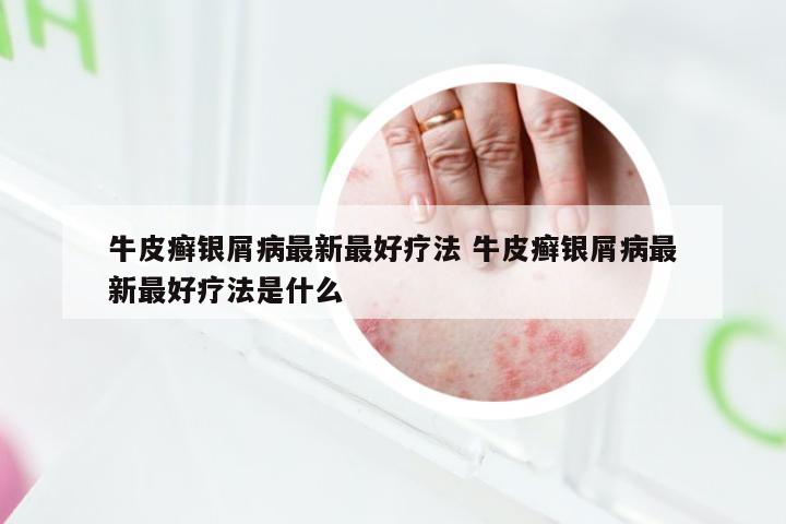 牛皮癣银屑病最新最好疗法 牛皮癣银屑病最新最好疗法是什么