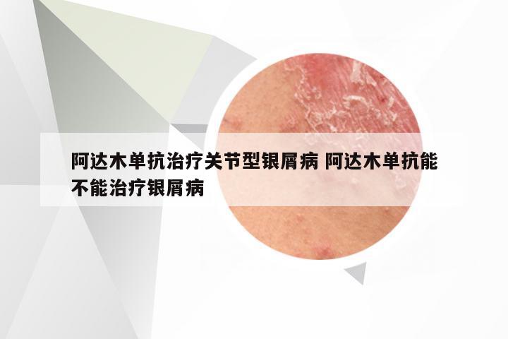 阿达木单抗治疗关节型银屑病 阿达木单抗能不能治疗银屑病