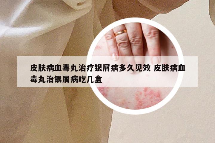皮肤病血毒丸治疗银屑病多久见效 皮肤病血毒丸治银屑病吃几盒