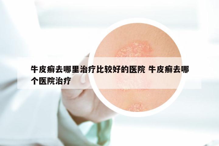 牛皮癣去哪里治疗比较好的医院 牛皮癣去哪个医院治疗
