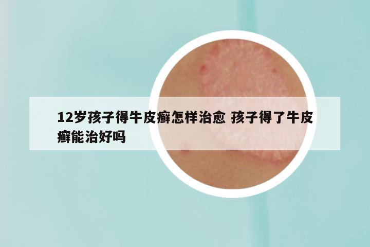 12岁孩子得牛皮癣怎样治愈 孩子得了牛皮癣能治好吗