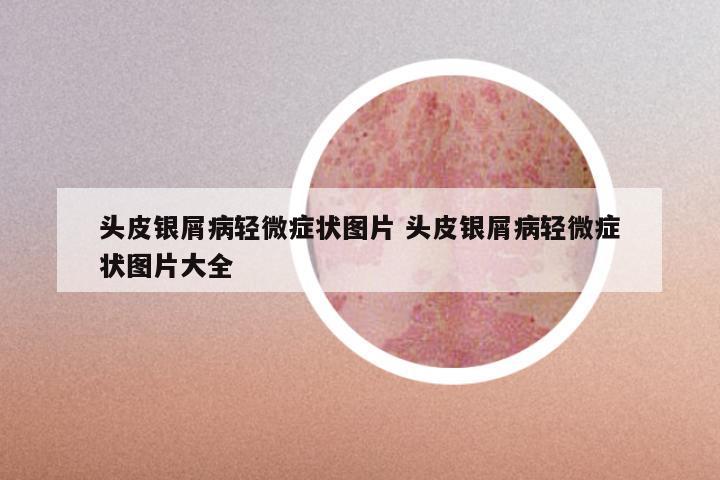 头皮银屑病轻微症状图片 头皮银屑病轻微症状图片大全