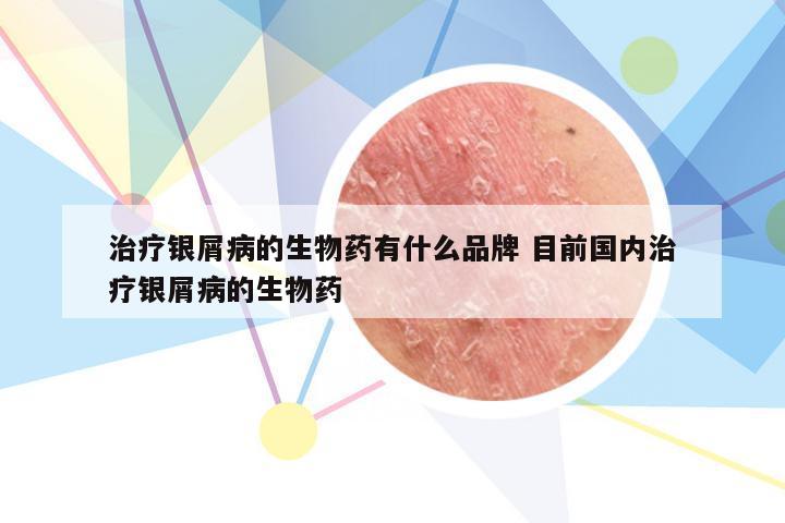 治疗银屑病的生物药有什么品牌 目前国内治疗银屑病的生物药