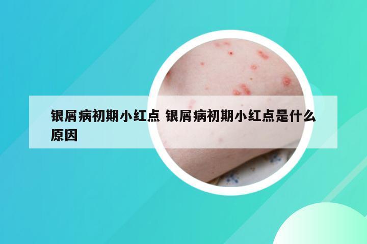 银屑病初期小红点 银屑病初期小红点是什么原因
