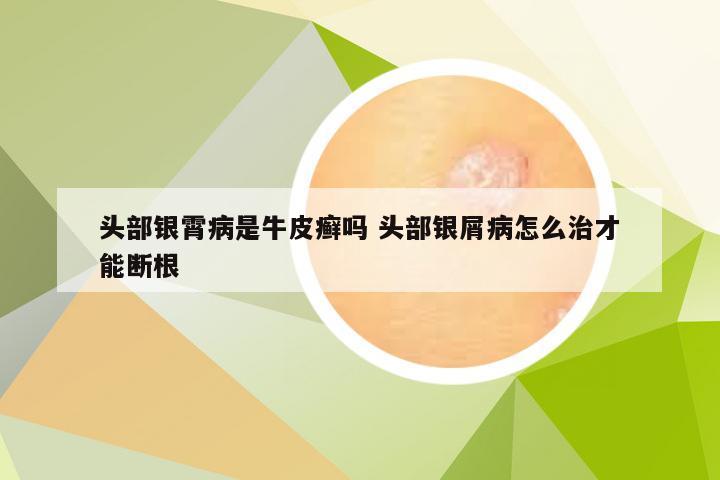 头部银霄病是牛皮癣吗 头部银屑病怎么治才能断根