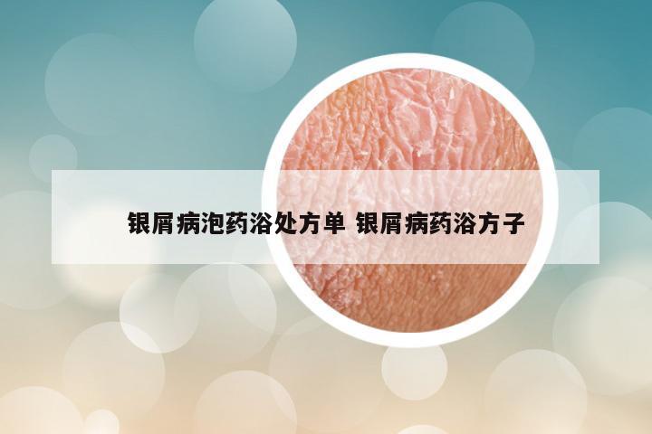 银屑病泡药浴处方单 银屑病药浴方子