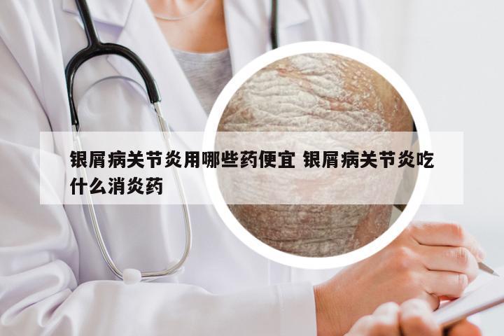 银屑病关节炎用哪些药便宜 银屑病关节炎吃什么消炎药