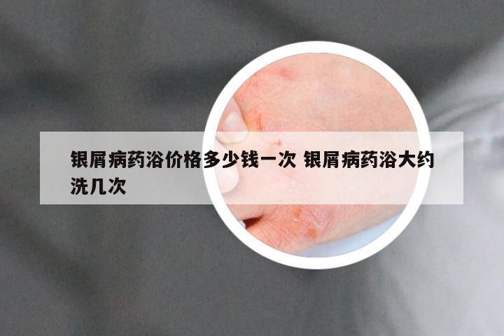 银屑病药浴价格多少钱一次 银屑病药浴大约洗几次