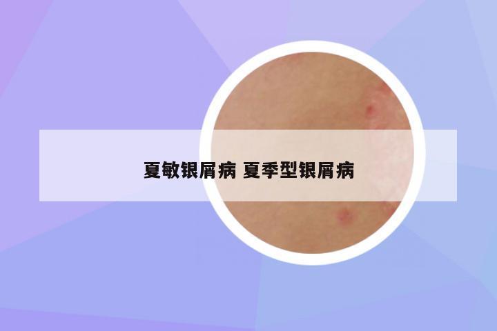 夏敏银屑病 夏季型银屑病