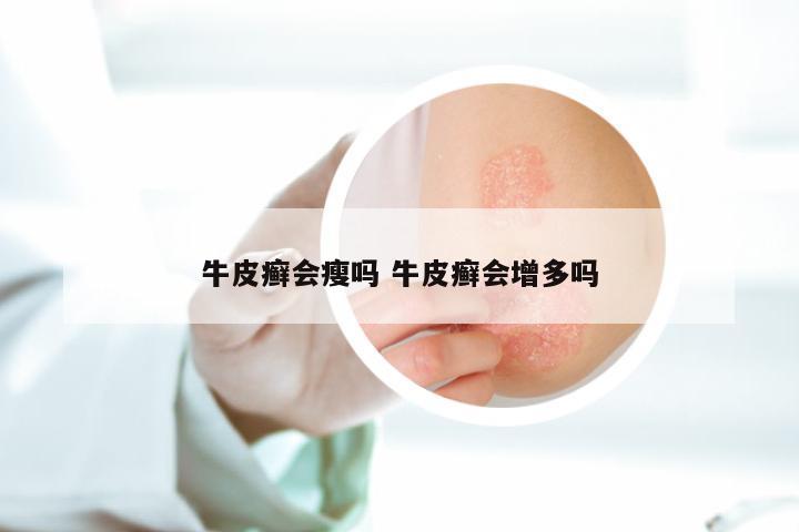 牛皮癣会瘦吗 牛皮癣会增多吗