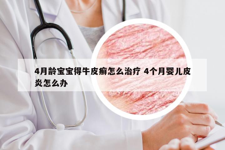 4月龄宝宝得牛皮癣怎么治疗 4个月婴儿皮炎怎么办