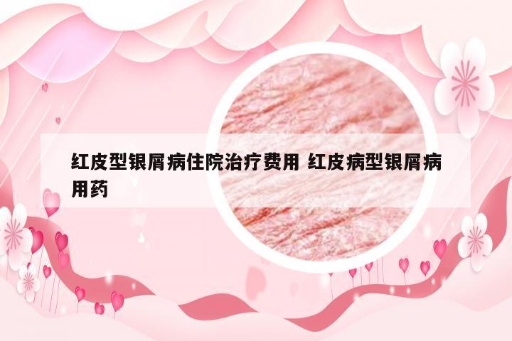 红皮型银屑病住院治疗费用 红皮病型银屑病用药