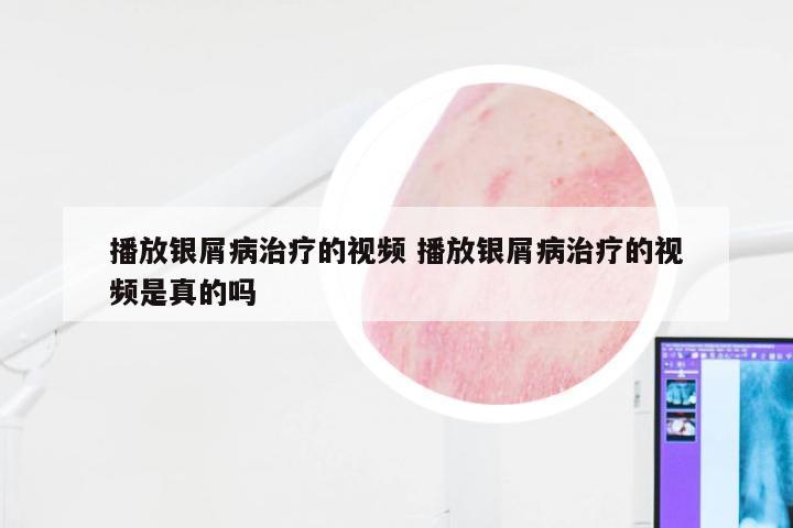播放银屑病治疗的视频 播放银屑病治疗的视频是真的吗