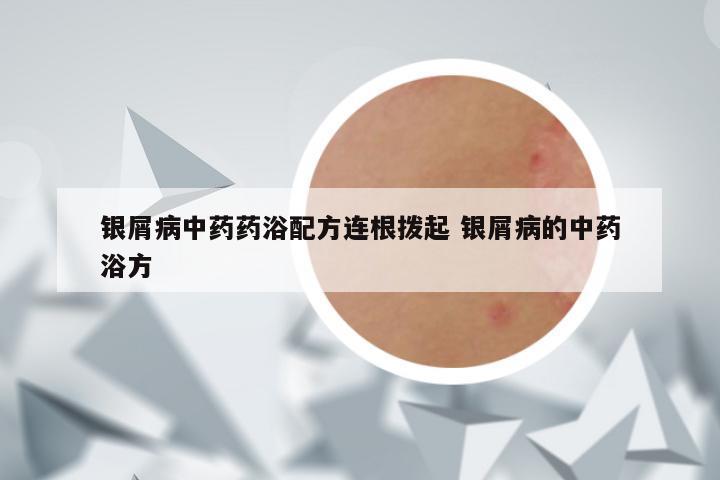 银屑病中药药浴配方连根拨起 银屑病的中药浴方