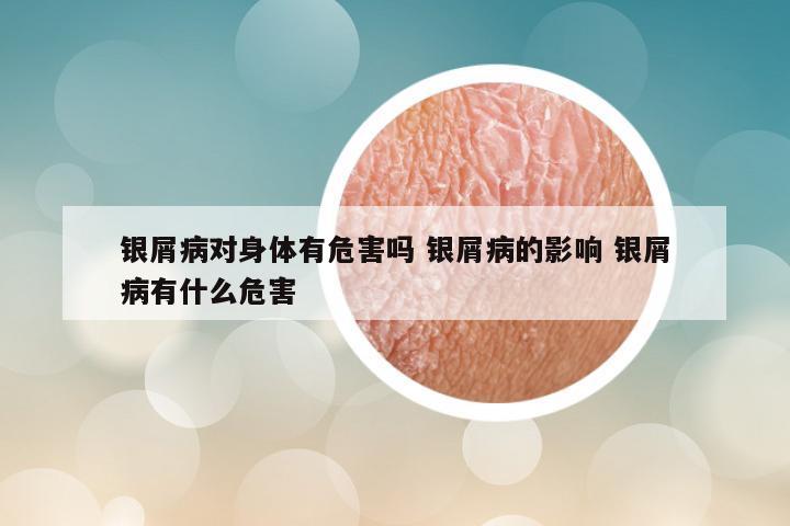 银屑病对身体有危害吗 银屑病的影响 银屑病有什么危害