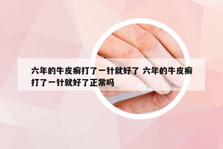六年的牛皮癣打了一针就好了 六年的牛皮癣打了一针就好了正常吗