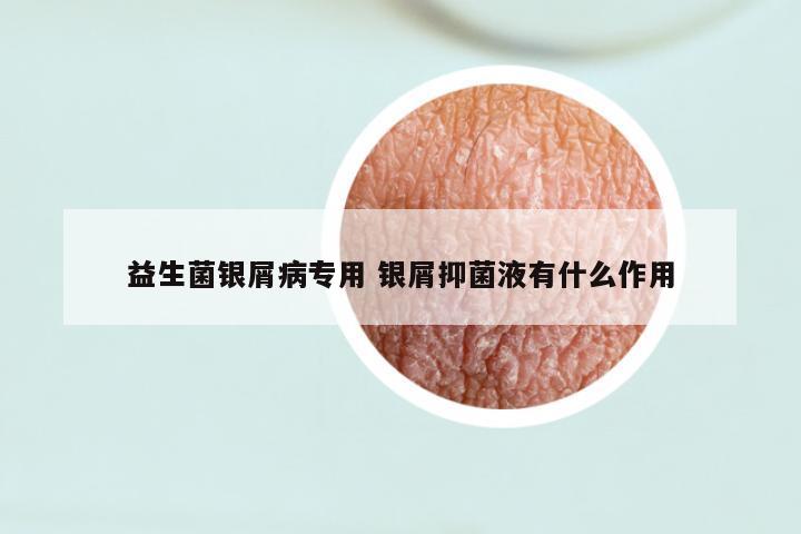 益生菌银屑病专用 银屑抑菌液有什么作用