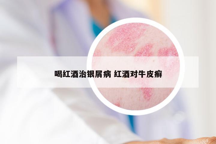 喝红酒治银屑病 红酒对牛皮癣