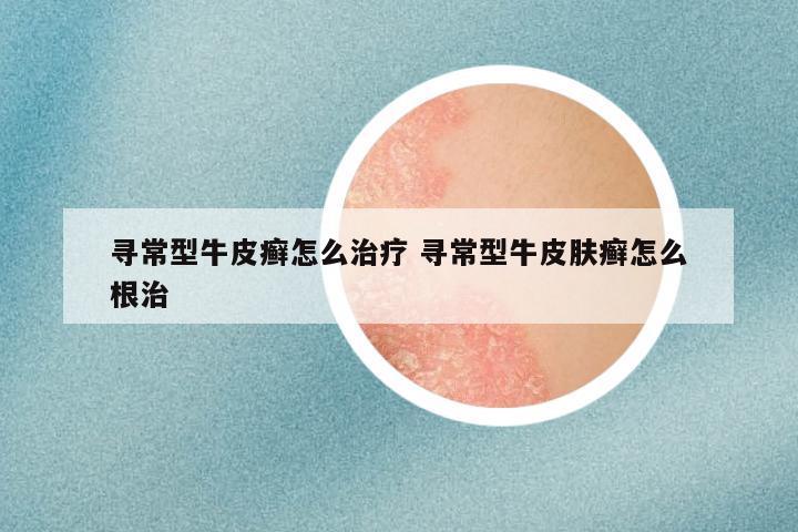 寻常型牛皮癣怎么治疗 寻常型牛皮肤癣怎么根治