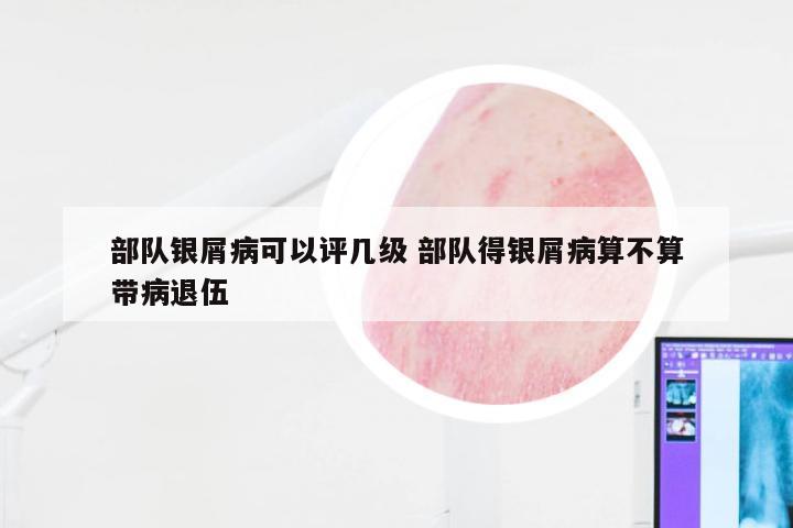 部队银屑病可以评几级 部队得银屑病算不算带病退伍