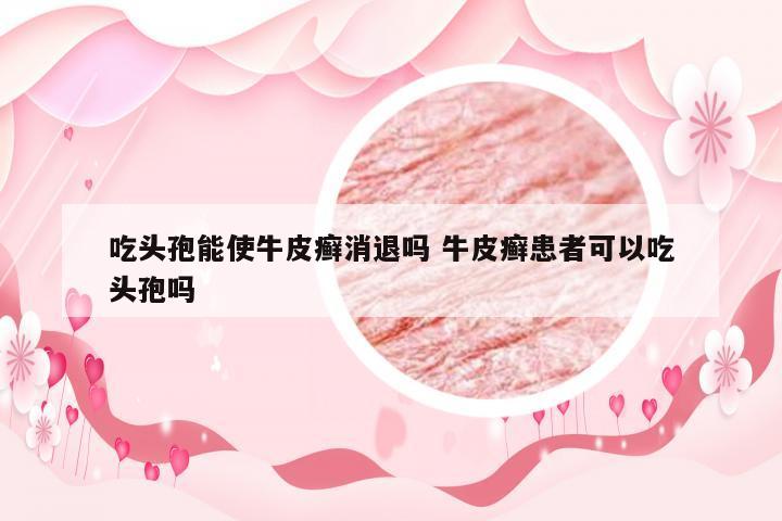 吃头孢能使牛皮癣消退吗 牛皮癣患者可以吃头孢吗