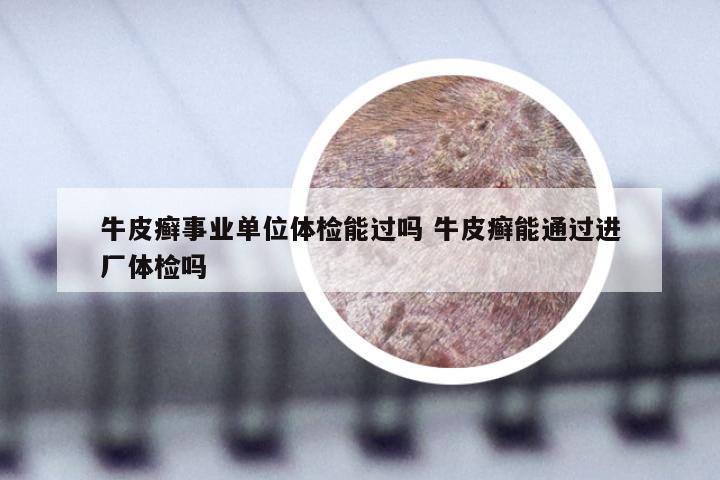 牛皮癣事业单位体检能过吗 牛皮癣能通过进厂体检吗