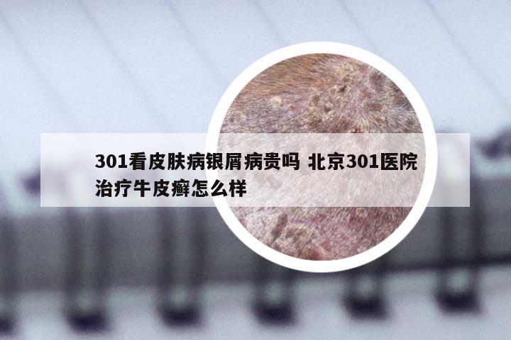 301看皮肤病银屑病贵吗 北京301医院治疗牛皮癣怎么样