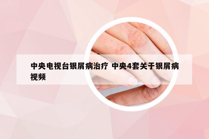 中央电视台银屑病治疗 中央4套关于银屑病视频