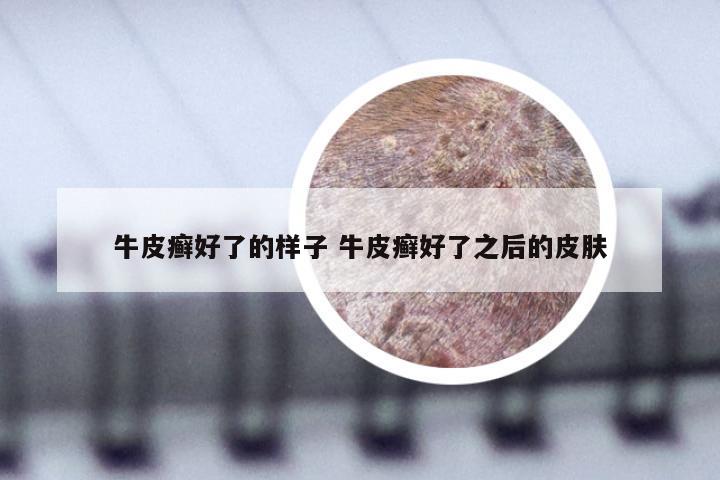 牛皮癣好了的样子 牛皮癣好了之后的皮肤