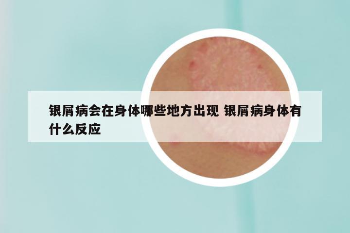 银屑病会在身体哪些地方出现 银屑病身体有什么反应