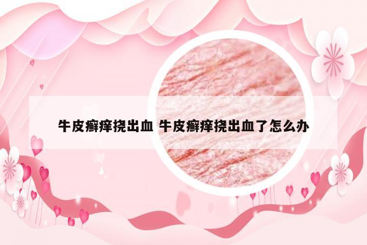 牛皮癣痒挠出血 牛皮癣痒挠出血了怎么办