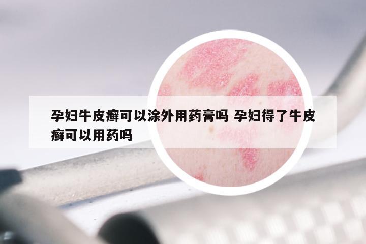 孕妇牛皮癣可以涂外用药膏吗 孕妇得了牛皮癣可以用药吗