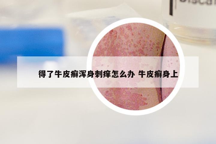 得了牛皮癣浑身刺痒怎么办 牛皮癣身上