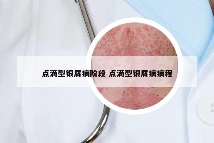 点滴型银屑病阶段 点滴型银屑病病程