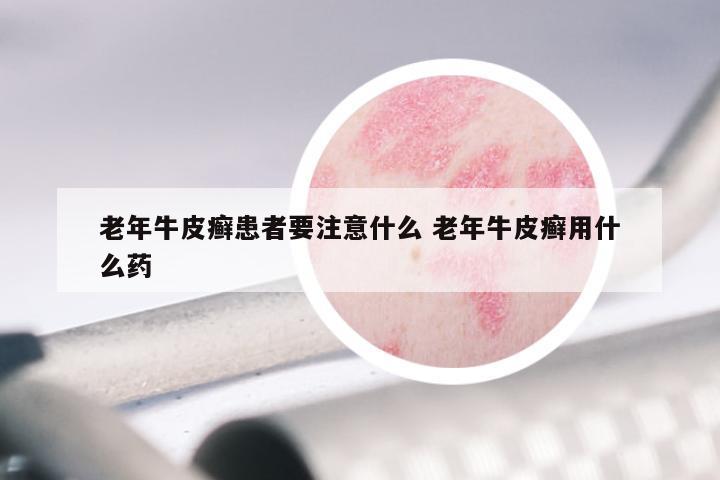老年牛皮癣患者要注意什么 老年牛皮癣用什么药