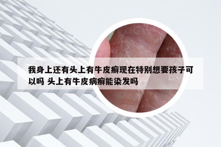 我身上还有头上有牛皮癣现在特别想要孩子可以吗 头上有牛皮病癣能染发吗