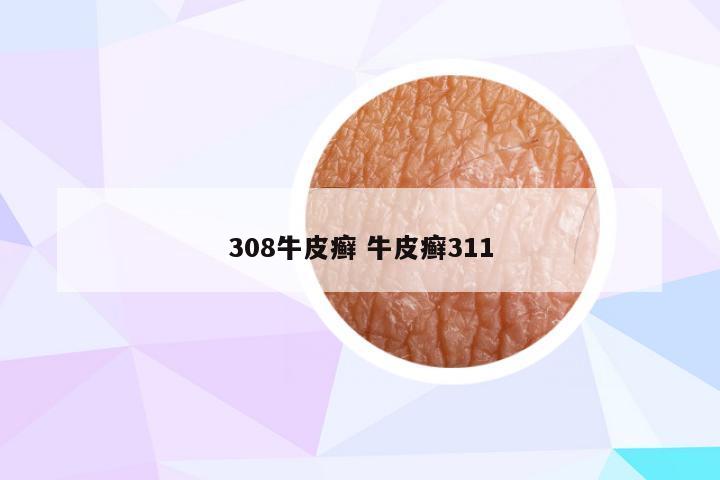 308牛皮癣 牛皮癣311