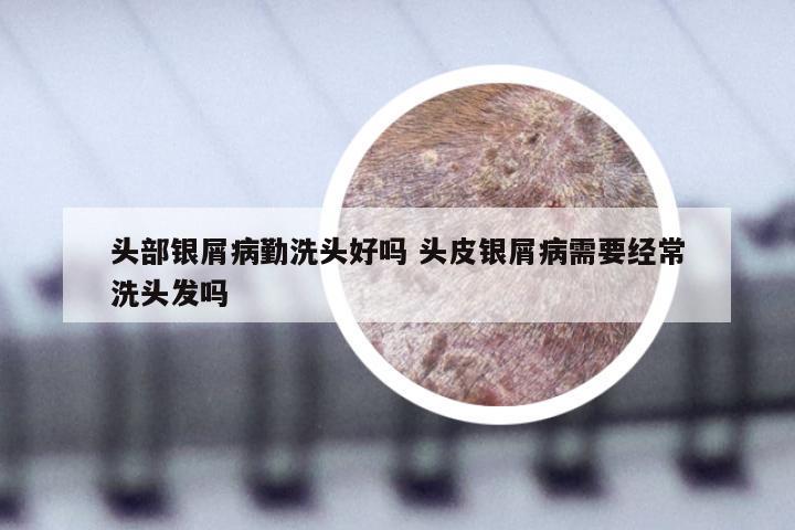 头部银屑病勤洗头好吗 头皮银屑病需要经常洗头发吗