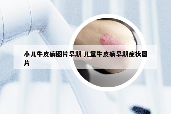 小儿牛皮癣图片早期 儿童牛皮癣早期症状图片