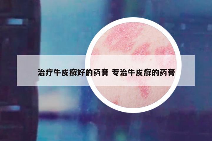 治疗牛皮癣好的药膏 专治牛皮癣的药膏