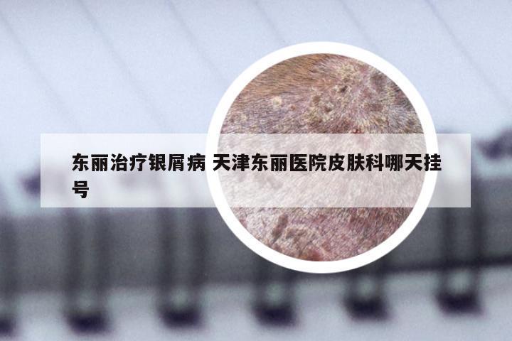东丽治疗银屑病 天津东丽医院皮肤科哪天挂号