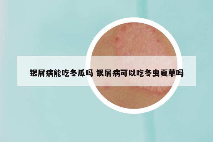 银屑病能吃冬瓜吗 银屑病可以吃冬虫夏草吗